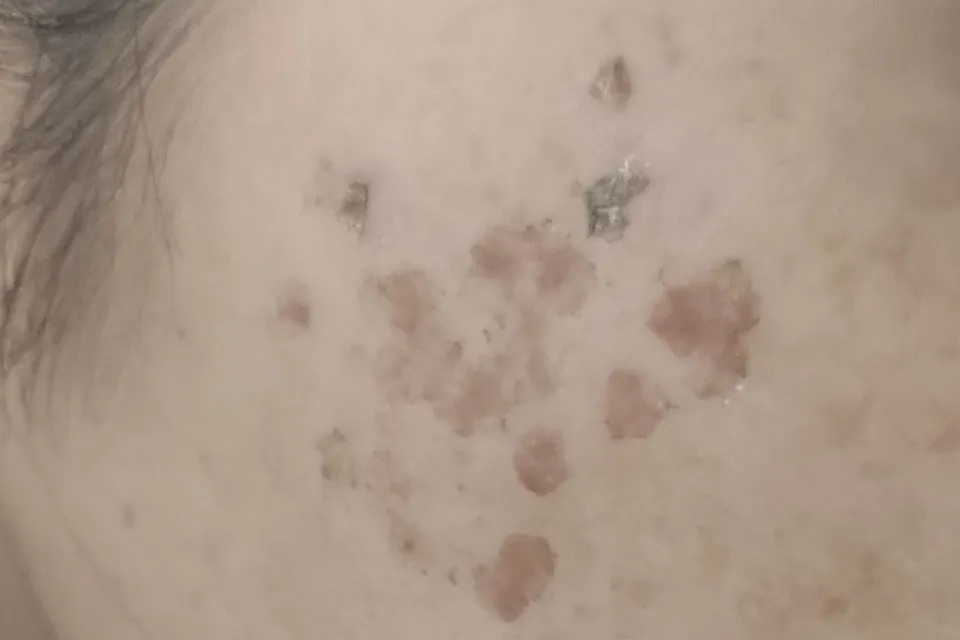 Qスイッチルビーレーザーによる施術