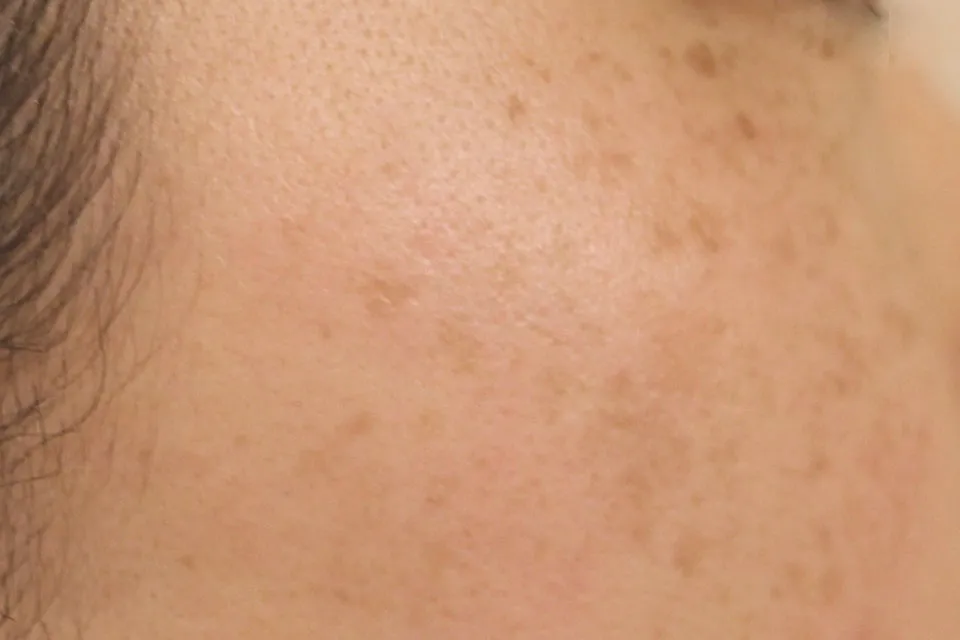 ADMタイプのシミ