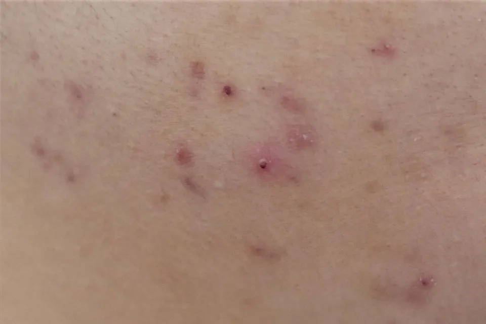 炎症後色素沈着タイプのシミ