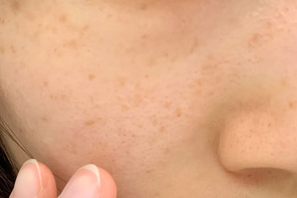 そばかすのある肌