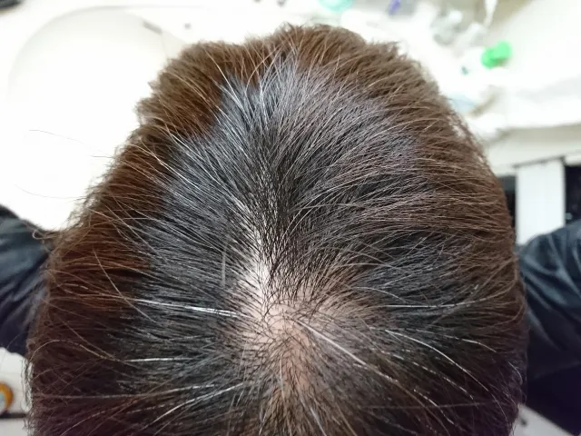 びまん性脱毛症