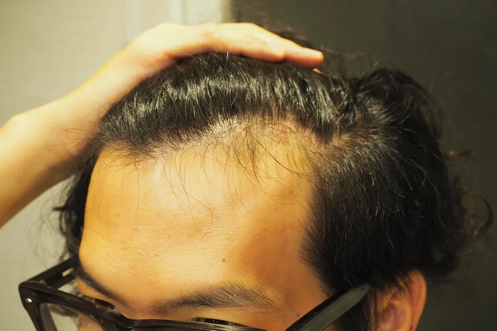 髪の生え際