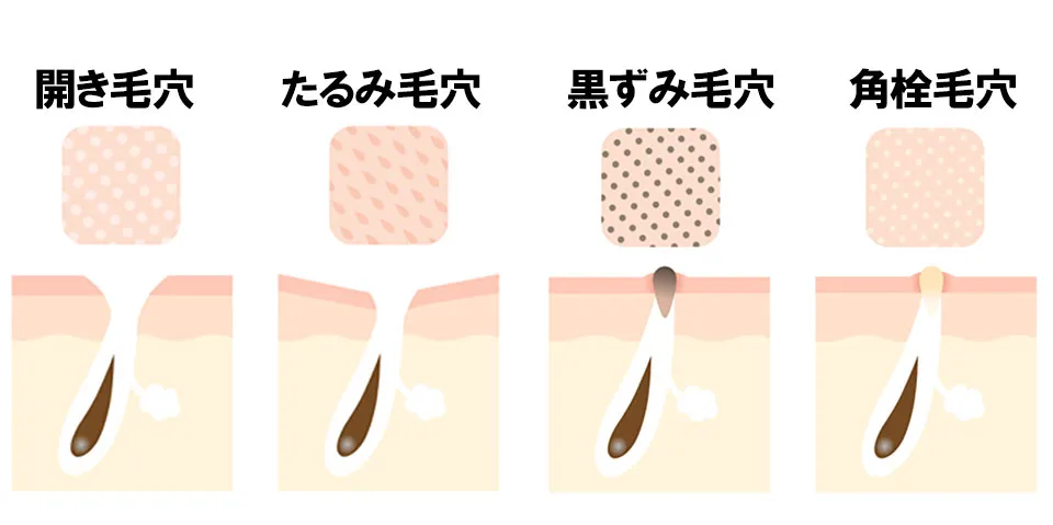 毛穴の種類の画像