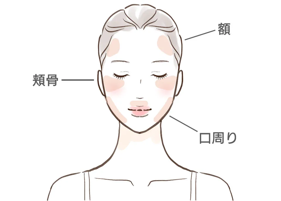 肝斑ができる場所を説明するイラスト