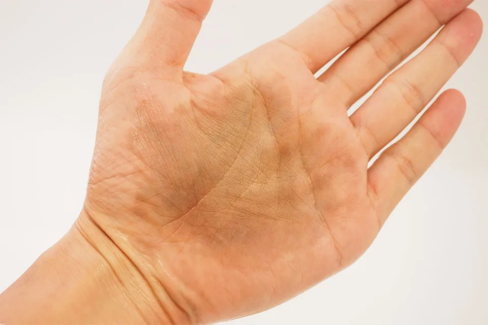 5分放置して水洗浄した手のひら