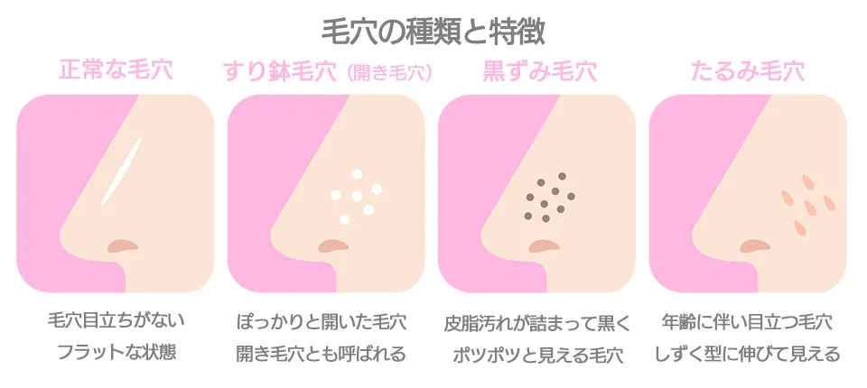 毛穴の種類イラスト