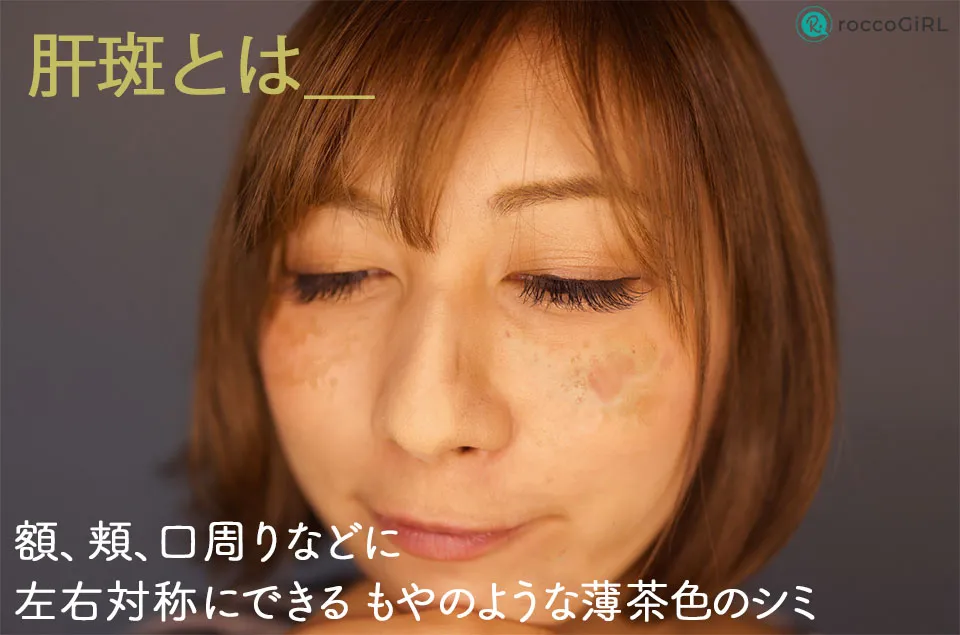 肝斑とはの症例写真