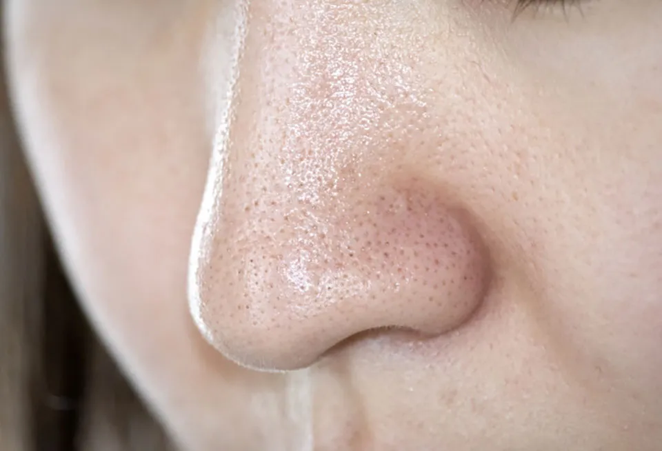 いちご鼻の女性