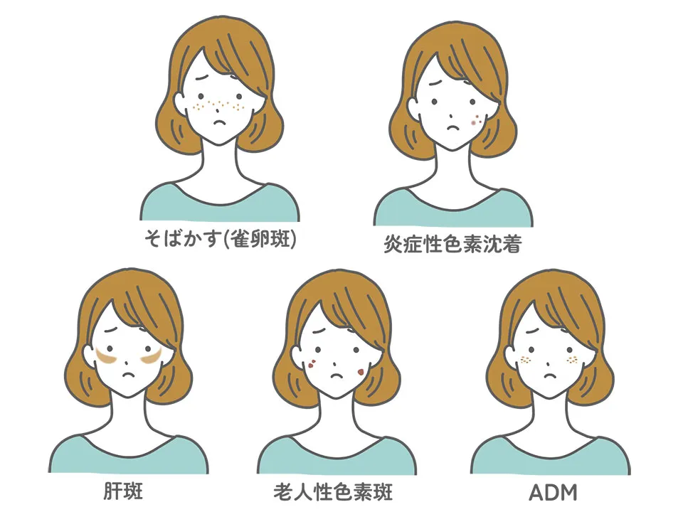 シミ種類の女性イラスト