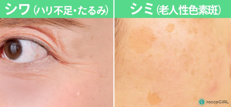 シワとシミの写真