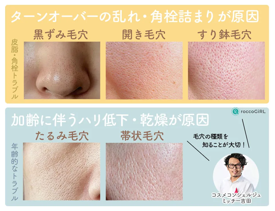 毛穴種類の解説