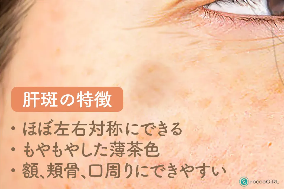 肝斑の特徴症例写真