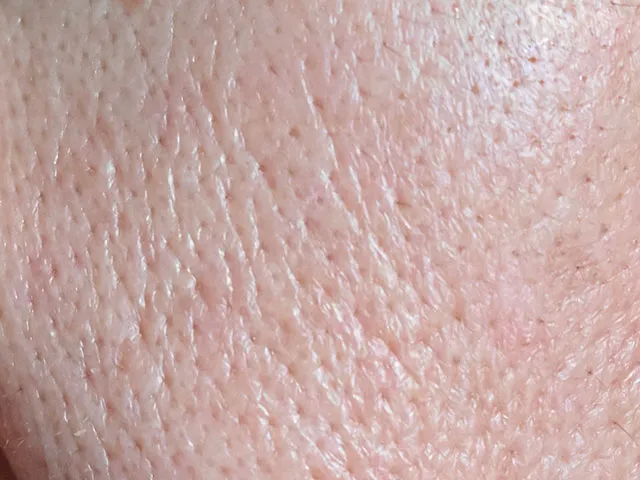 帯状毛穴