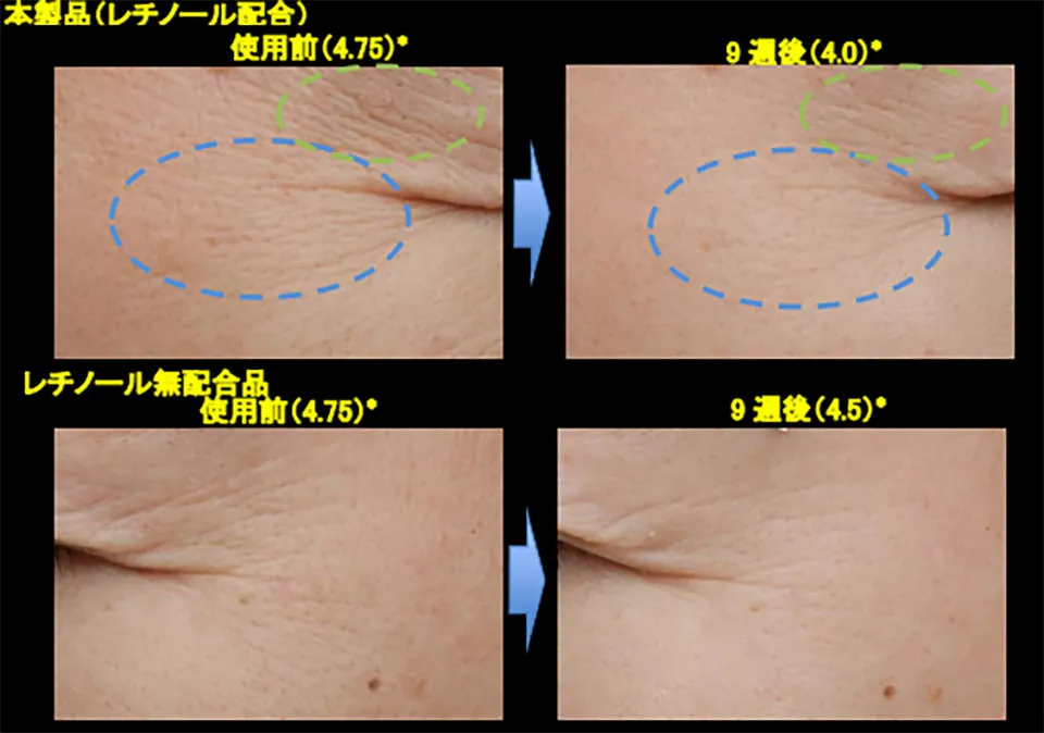 レチノールシワ改善シワグレード解説写真