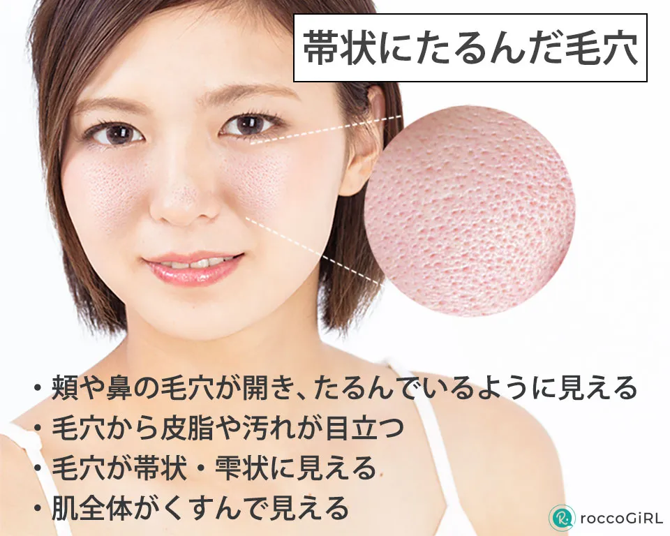 たるみ毛穴解説