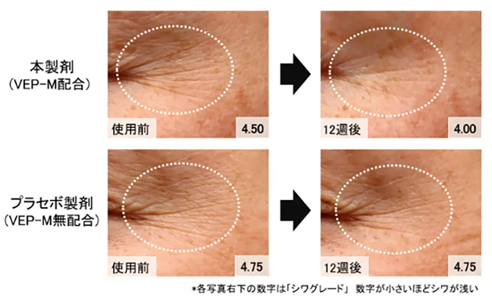 VEP-Mシワ改善グレード解説写真