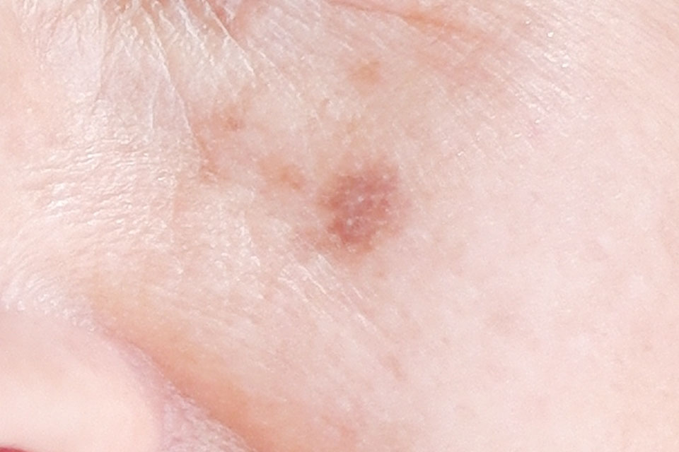 老人性色素斑の写真