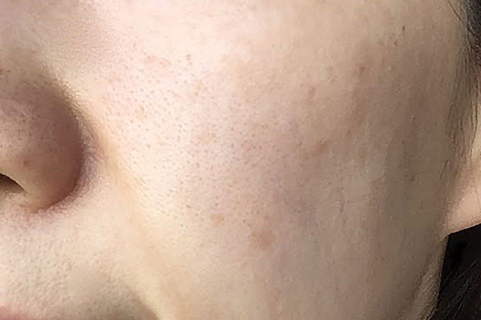 肝斑タイプのシミ