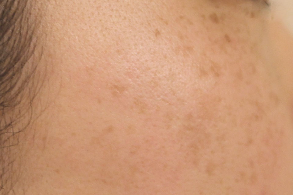 ADMタイプのシミ