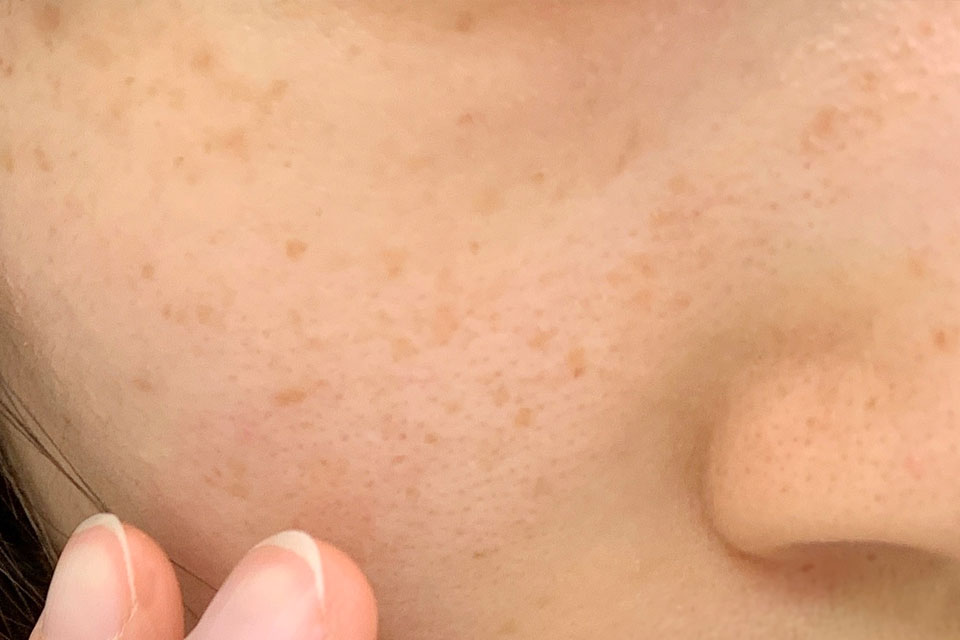 そばかすのある肌