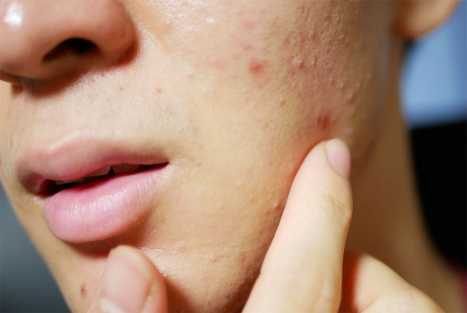 男性の大人ニキビ
