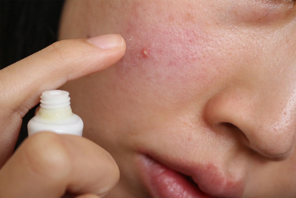 女性のニキビ肌