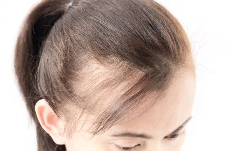 女性の薄毛の原因と対策 実践できる増毛・育毛を促す効果的な方法を紹介 RoccoGirl