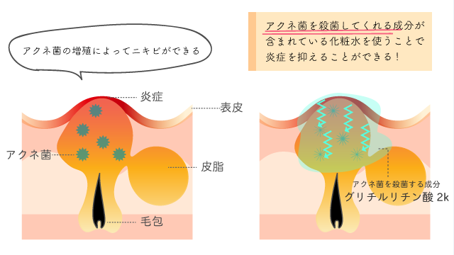 アクネ菌によるニキビのでき方