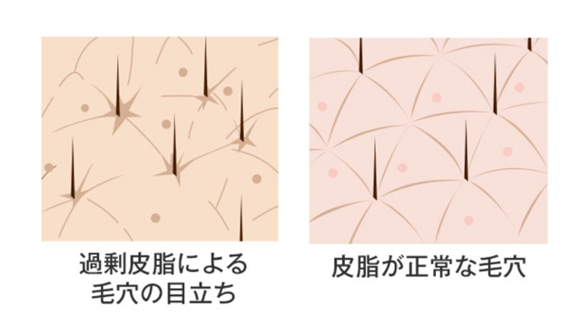 毛穴の図