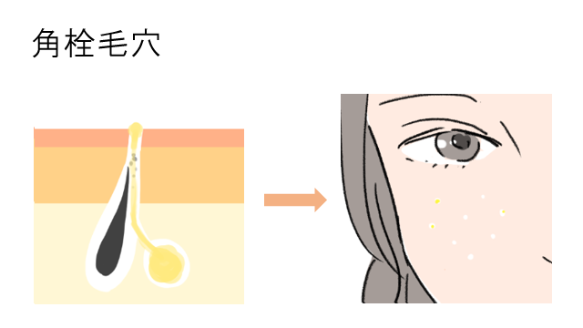 角栓毛穴