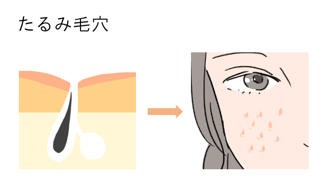 たるみ毛穴