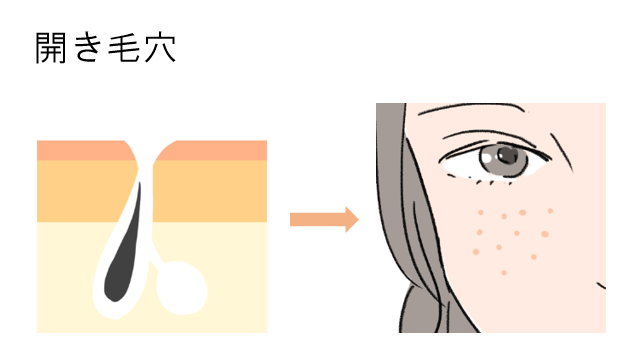 開き毛穴