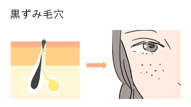 黒ずみ毛穴
