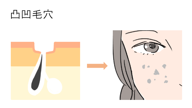 凸凹毛穴