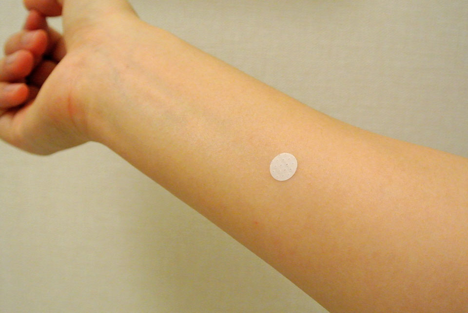 アレルギーテストをする女の人の腕の写真