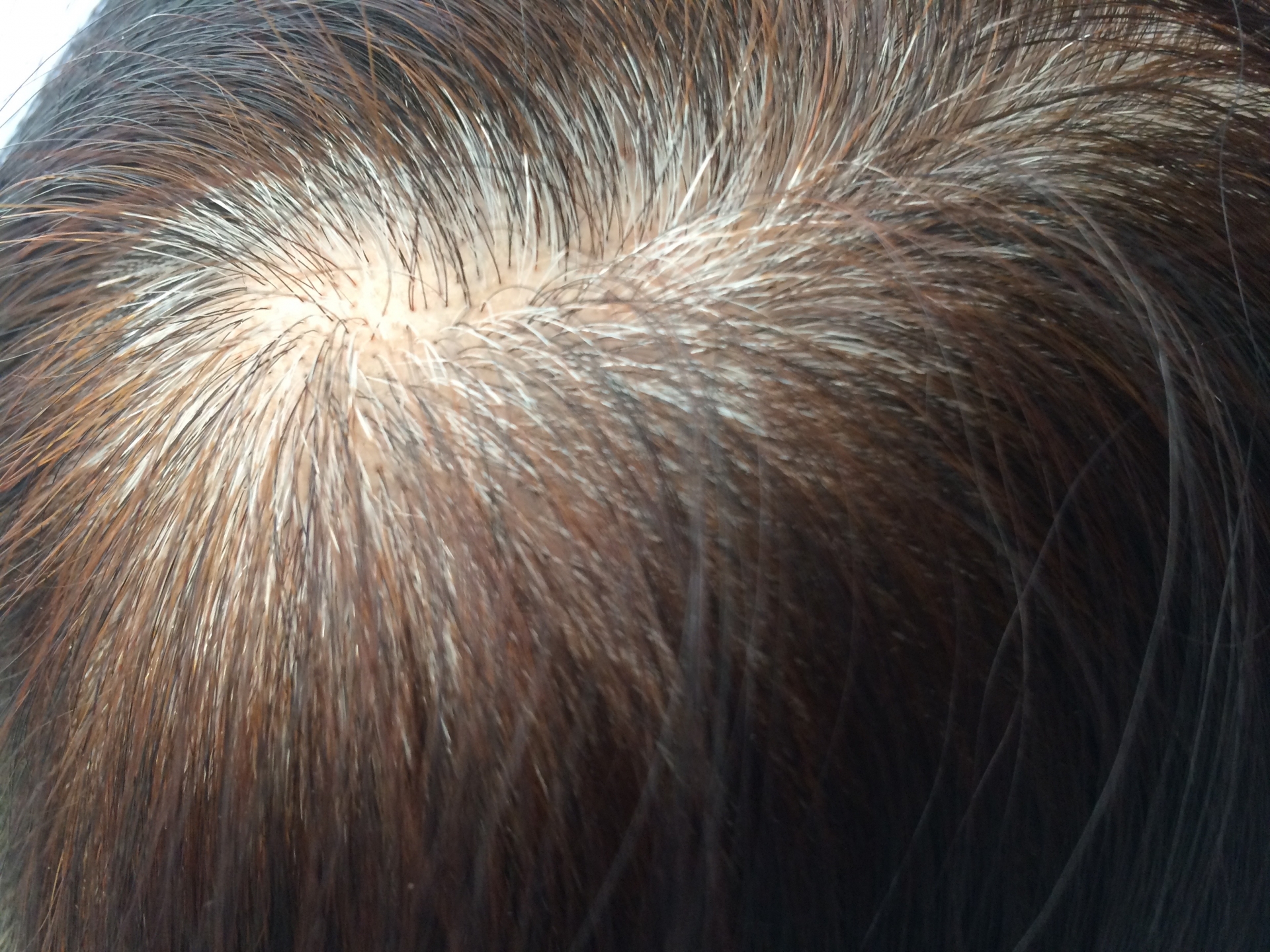 女性の薄毛の原因と対策実践できる増毛育毛を促す効果的な方法を紹介