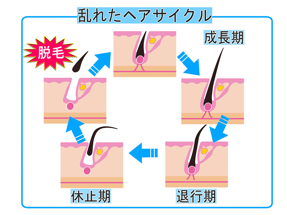 乱れたヘアサイクルの画像