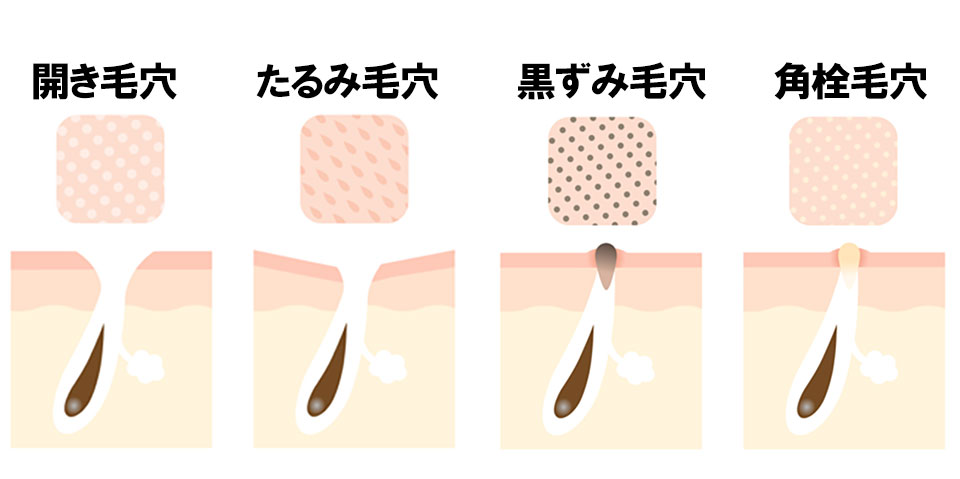 毛穴の種類の画像