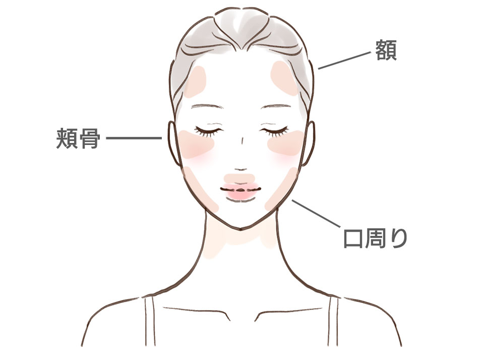 肝斑ができる場所を説明するイラスト