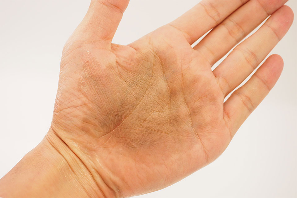 5分放置して水洗浄した手のひら