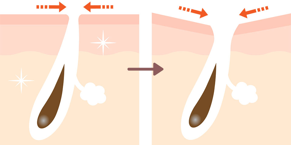 たるみ毛穴の説明イラスト