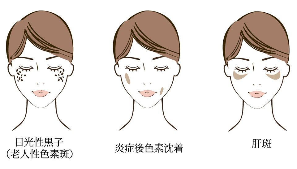 シミ種類女性のイラスト