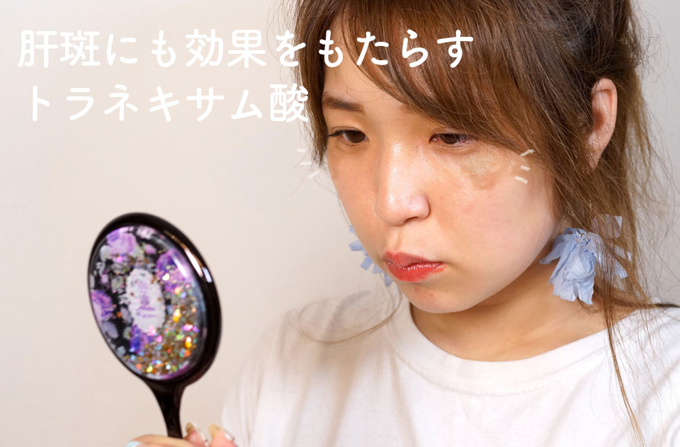 トラネキサム酸と肝斑がある女性の写真