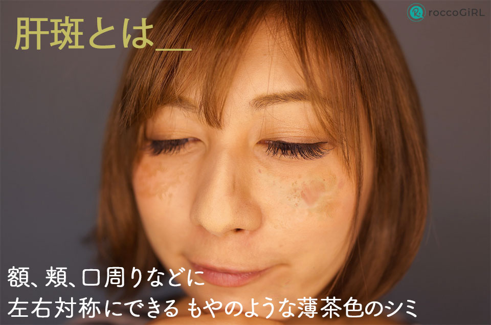 肝斑とはの症例写真