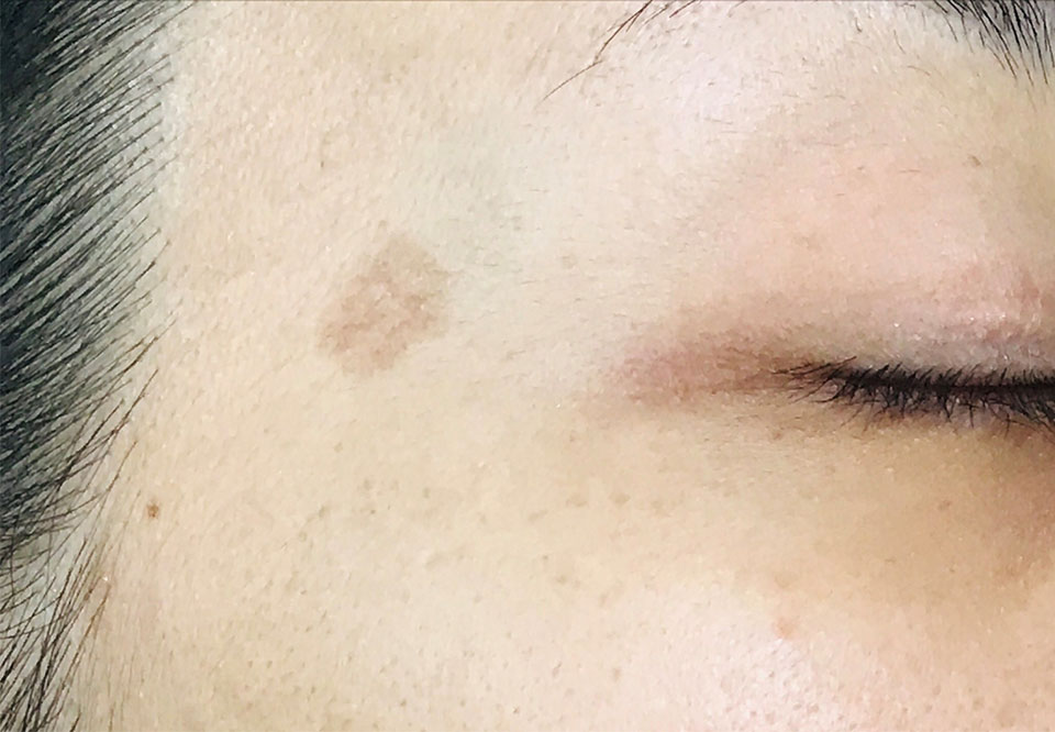 女性のシミの写真