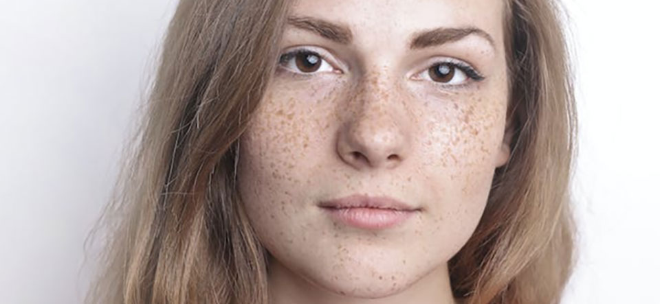 そばかすがある女性の写真