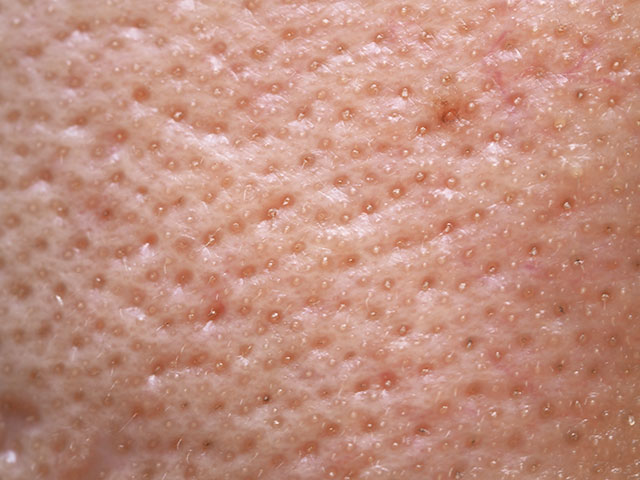 角栓詰まり毛穴