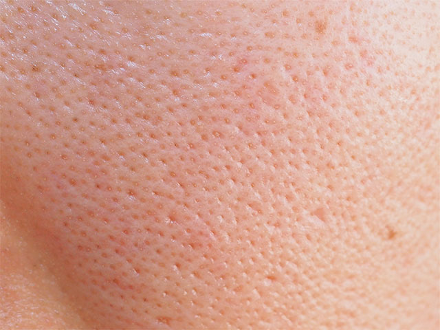 開き毛穴