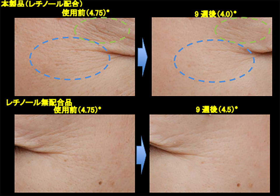 レチノールシワ改善シワグレード解説写真