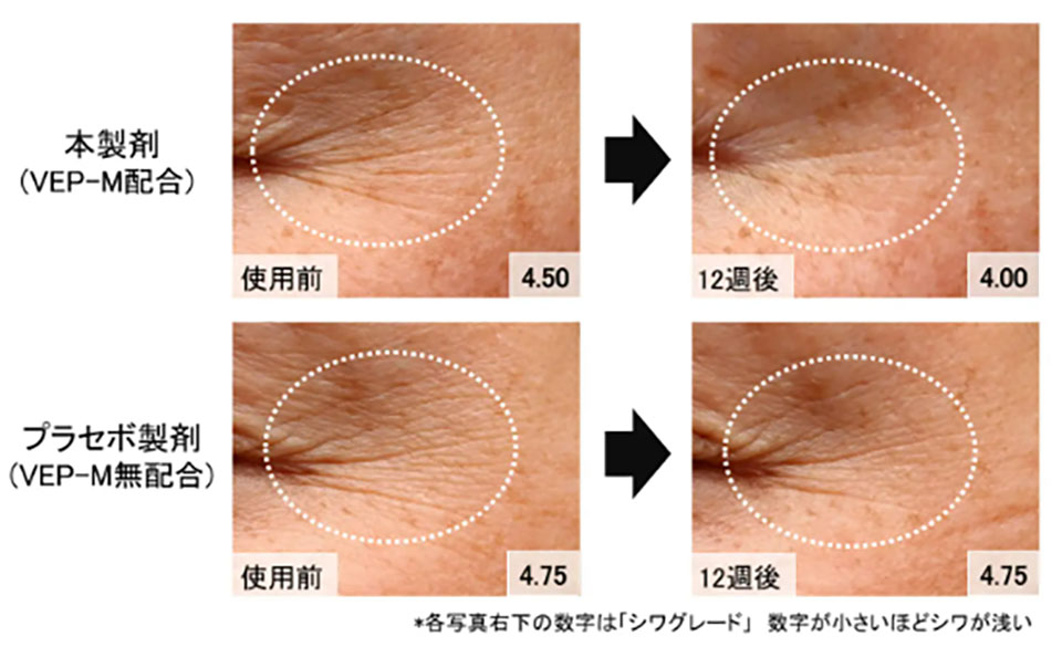 VEP-Mシワ改善グレード解説写真